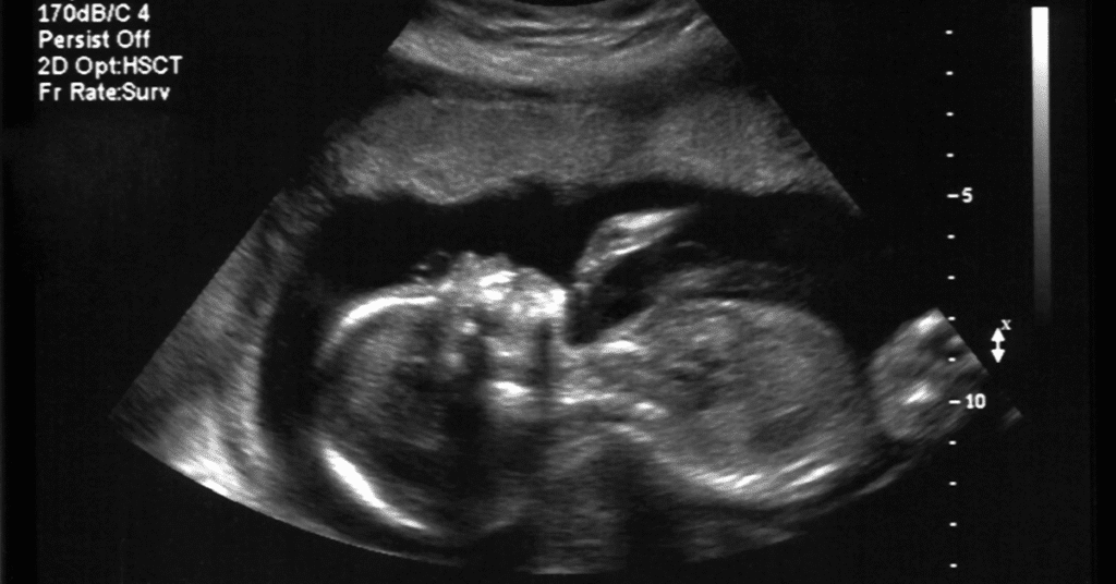 trauma in the womb 1