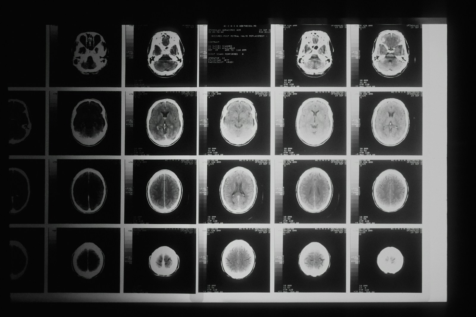 Black and white MRI brain scan images displayed on a screen